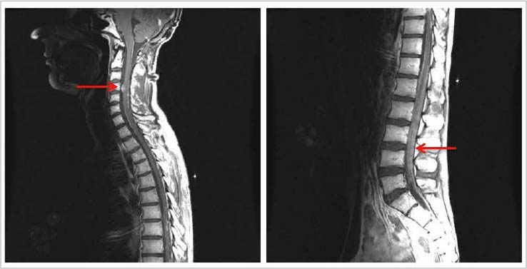 Leptomeningeal carcinomatosis from solid tumours: a systematic review