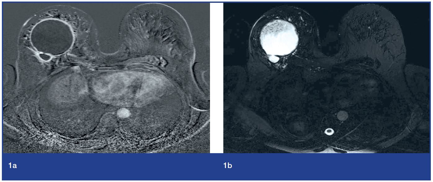 Case Report Squamous Cell Carcinoma Of The Breast A Rare Cancer Bjmo