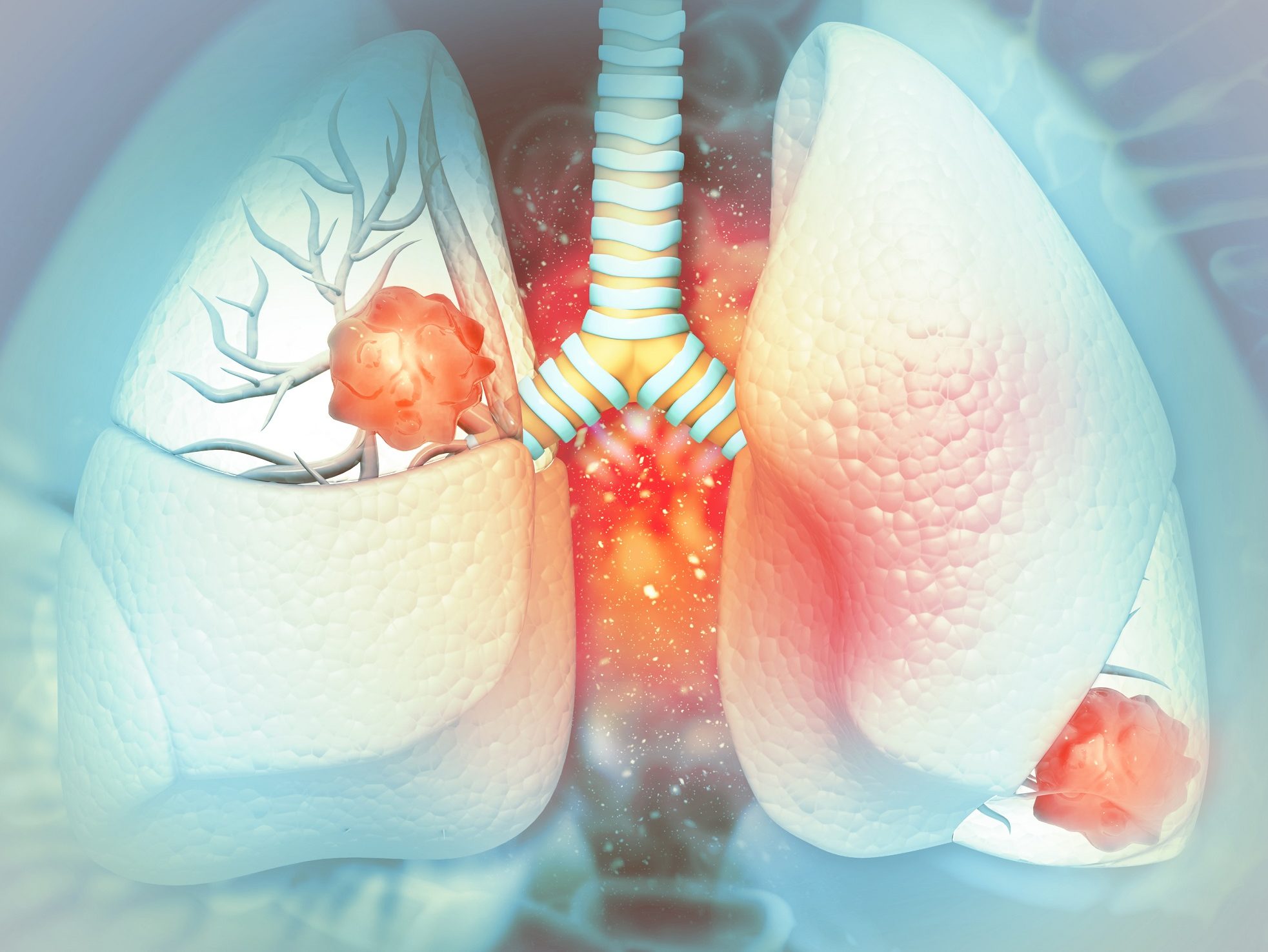 Durvalumab Plus Platinum Etoposide Shows Significant Overall Survival Improvement Bjmo