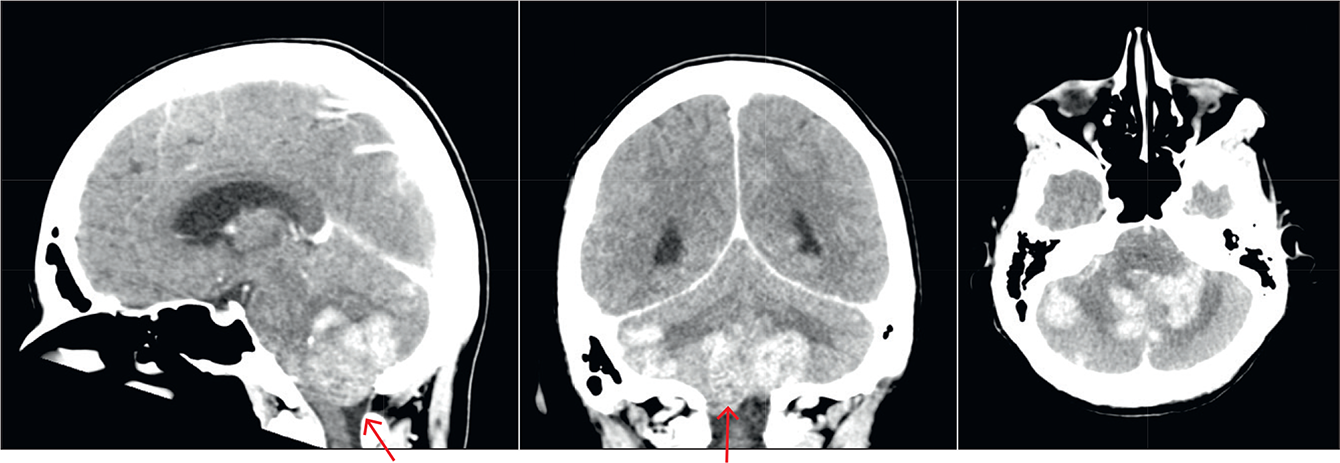 A case of HER2positive breast cancer with rapidly